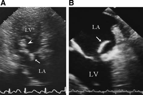 Two Cases Of Calcified Amorphous Tumor Mimicking Mitral Valve