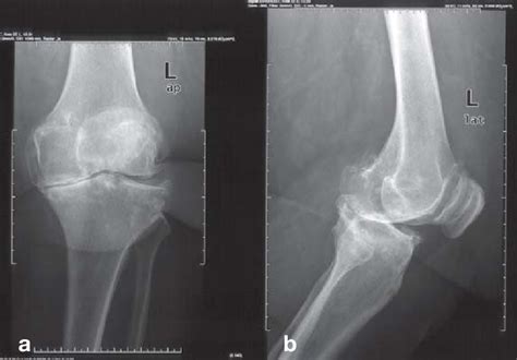 Knee arthritis is known to affect joint functionality causing knee pain and even leading to disability as it progresses. Plain x-rays of the left knee in Kellgren and Lawrence ...