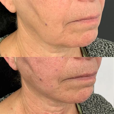 Best Non Surgical Treatment For Jowls In 2023 Martlabpro