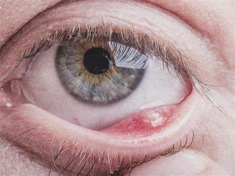 Stye Inside Eyelid Internal Stye How To Identify And Treatments