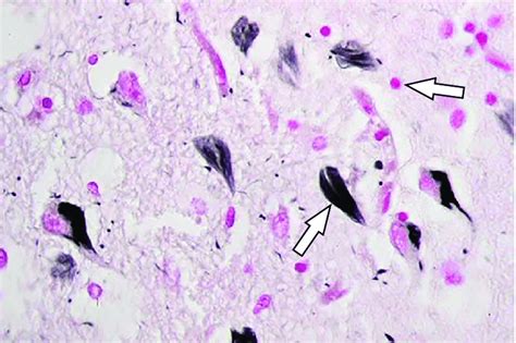 Amyloid Plaques Pink And Neurofibrillary Tangles Black In