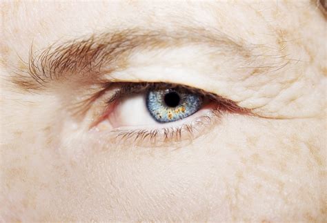 Baggy Eyelids Dermatochalasis Symptoms And Treatment — Grosinger