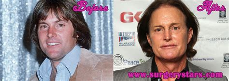 Worst Plastic Surgery Bruce Jenner Pictures