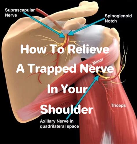 The 3 Minute Rule For Trapped Nerve In Neck And Shoulder Nerve Zone