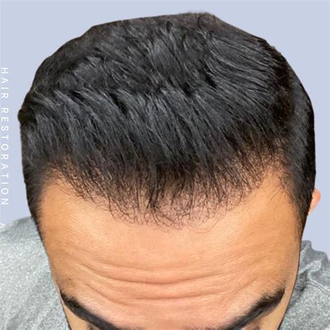 Hair Restoration Before And After Photos Dr Hardik Doshi