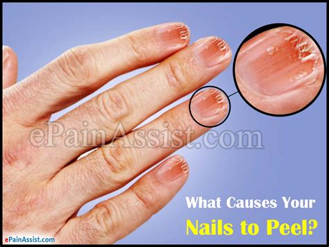 Peeling Finger Nails What Causes Your Nails To Peel And How To Fix It