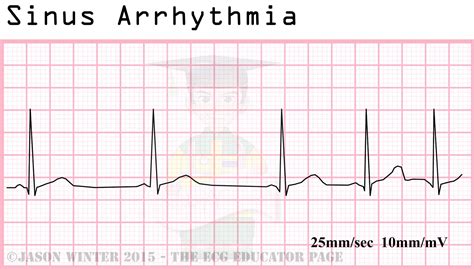 Ecg Educator Blog Sinoatrial Node Rhythms