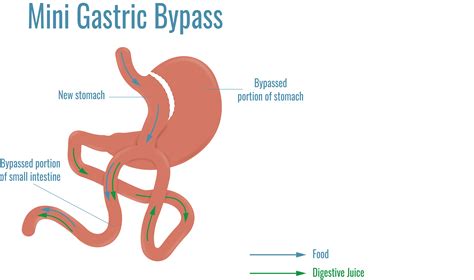 Mini Gastric Bypass Surgery Pros And Cons Rufusburker