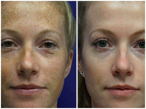 Bbl Photofacial Skin Rejuvenation At Pynch Anti Aging