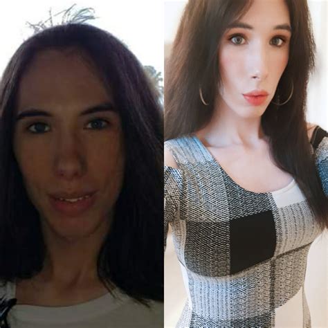 2 Years Hrt Injections 450cc Implants Transtimelines