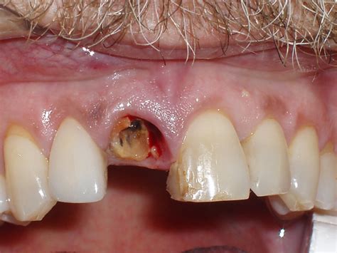 Dental Implants Austin Dentist Mike Williamson Dds Ms