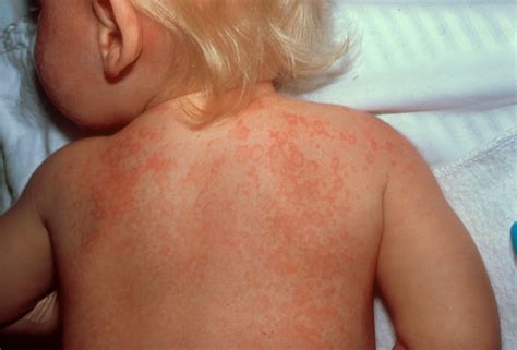 Doença De Kawasaki é Contagiosa