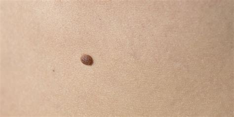 Identifying Skin Cancer 33 Photos That Could Save Your Life Weather