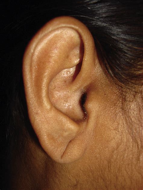 The Anatomy Of The Split Ear Lobe Journal Of Plastic Reconstructive