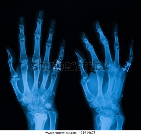 Pa Oblique Views Hand Include Wrist Stock Photo Edit Now 491914675