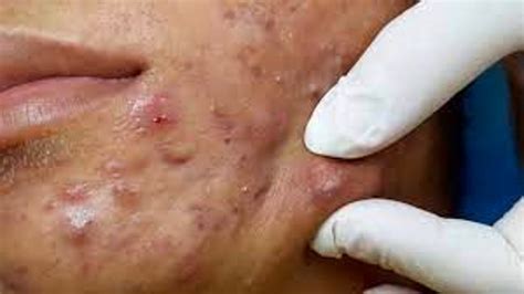 Crazy Popping Huge Blackheads And Pimple Popping Best Pimple Popping