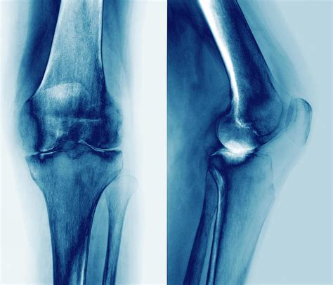 Arthritic Knee Photograph By Zephyrscience Photo Library Pixels