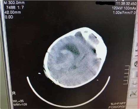 Computed Tomography Showing A Heterogeneous Mass In The Right Lateral