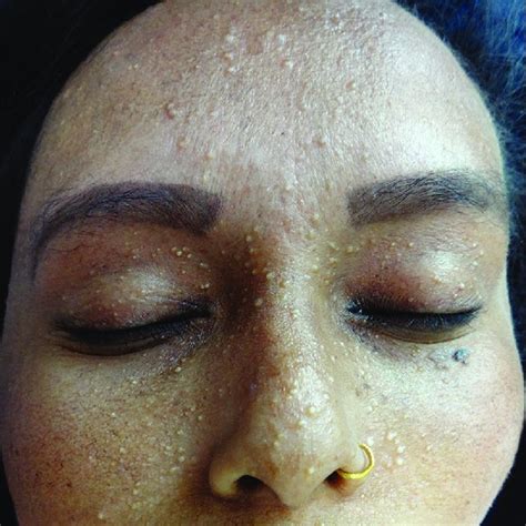 Multiple Facial Milia Characteristic Appearance Of Nose And Sparse
