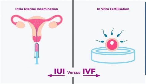 Intrauterine Insemination Iui Vs In Vitro Fertilization Ivf Kjk