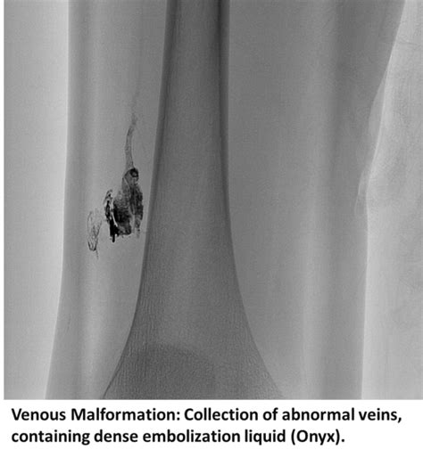Venous And Lymphatic Malformations Interventional Radiology Ucla Health