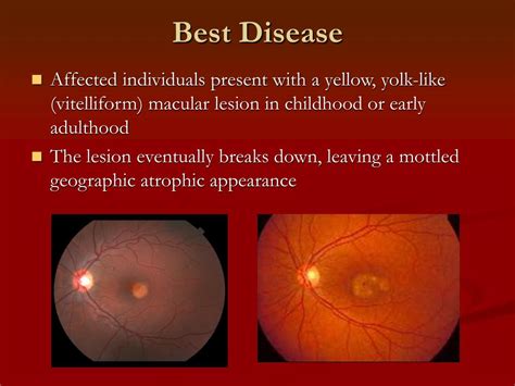 Ppt Grand Rounds Best Disease Powerpoint Presentation Free Download
