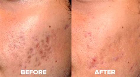 Can Acne Scars Be Removed Completely Silveryguy
