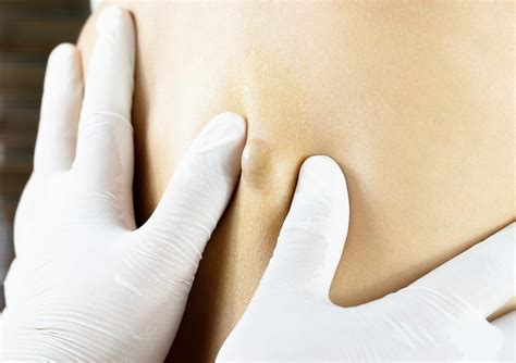Cyst And Lipoma Removal Us Dermatology Partners