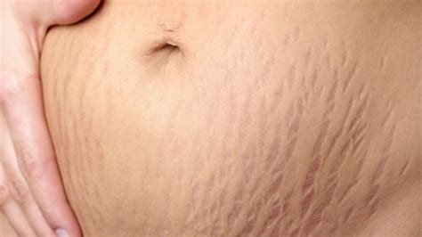Tattoo Artist Hides Stretch Marks With Skin Colored Ink Before And