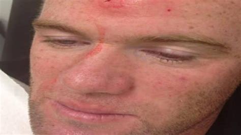 Wayne Rooney Posts Injury Pictures On Facebook Itv News