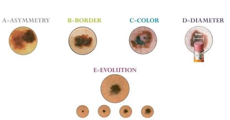What Are The Symptoms Of An Early Stage Melanoma Quora