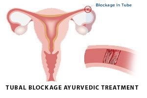 Blocked Fallopian Tube Treatment Naturally Tubal Blockage Ayurvedic