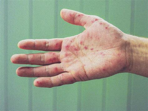 Types Of Rashes On Palms