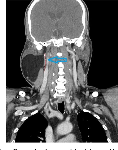 Figure 2 From Giant Lipoma Of The Face And Neck A Case Report