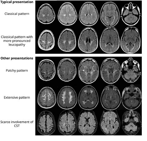 Figure 2 From Brain Mri Features And Scoring Of Leukodystrophy In Adult
