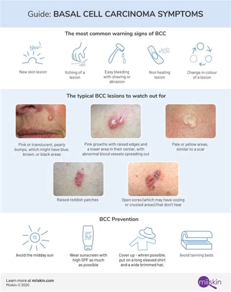 Basal Cell Carcinoma Symptoms Signs And Lesions Skin Mapping Squamous