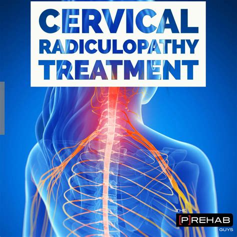 Cervical Radiculopathy Nerve