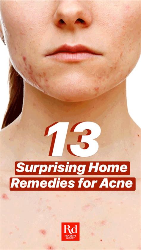12 Surprising Home Remedies For Acne Home Remedies For Acne Acne