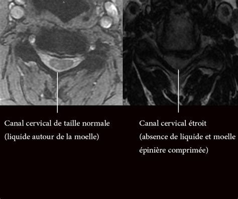 Le canal cervical étroit et la myélopathie cervicarthrosique