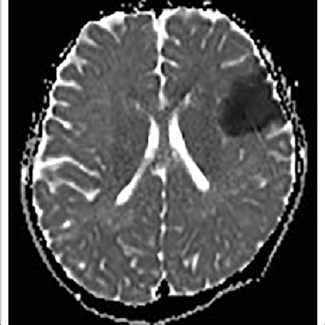 A Cerebral Mri Scan Slice Showing A Fresh Infarction In The Left