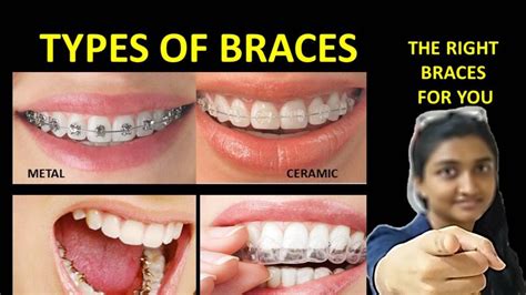 Types Of Braces Pros And Consbest Braces For Teeth Youtube