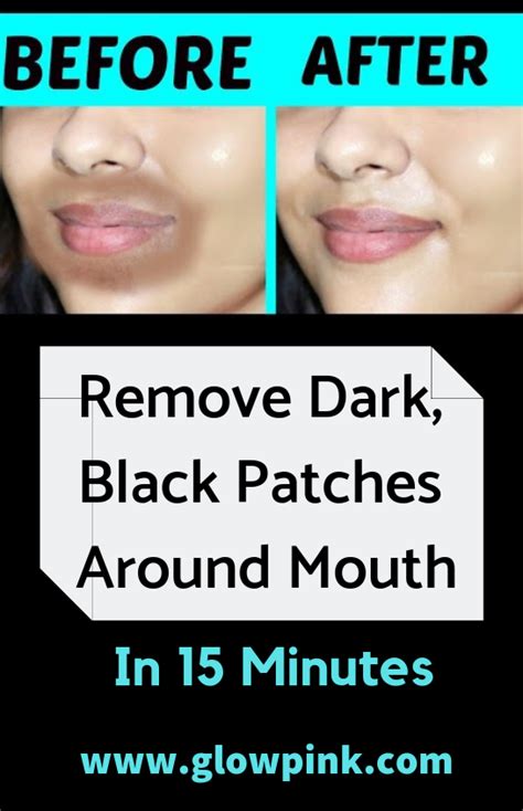 How To Get Rid Of Blackheads Under Lip Howtoremvo
