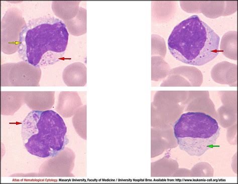 T Cell Large Granular Lymphocytic Leukaemia Cell Atlas Of