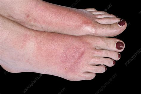 Sunburn On The Feet Stock Image C0401014 Science Photo Library