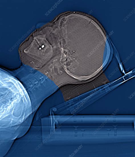 Radiotherapy For Brain Cancer Ct Scan Stock Image M7050164