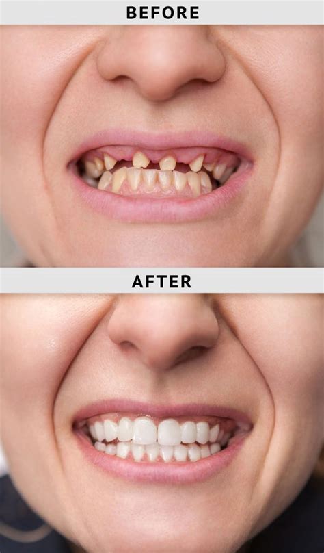 Veneers Denora