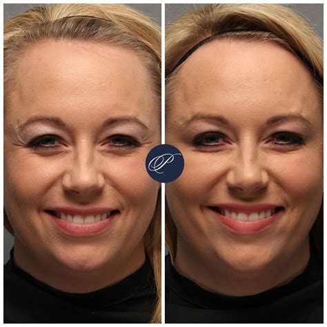 Smile Lines Botox Before And After