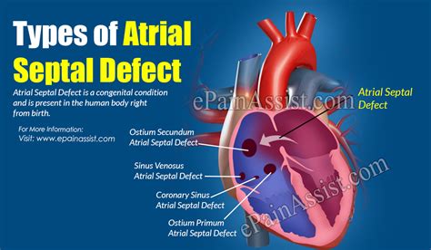 Types Of Atrial Septal Defect Its Causes Symptoms