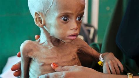 14m Children In Somalia To Suffer Acute Malnutrition In 2017 Unic