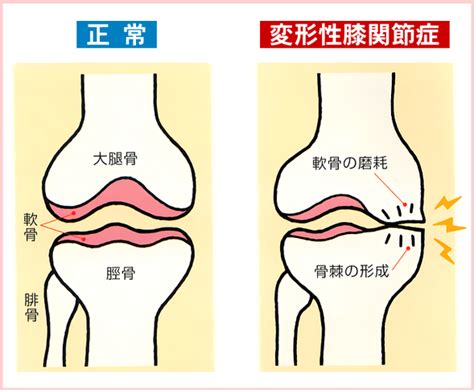 変形性膝関節症の原因は ｜吹田、茨木、高槻、摂津、大阪